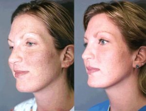 Antes y Después del Rejuvenecimiento Facial con Láser CO2